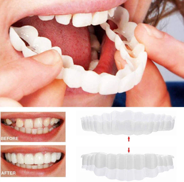 On Smile Veneers Upper and Lower Teeth Set