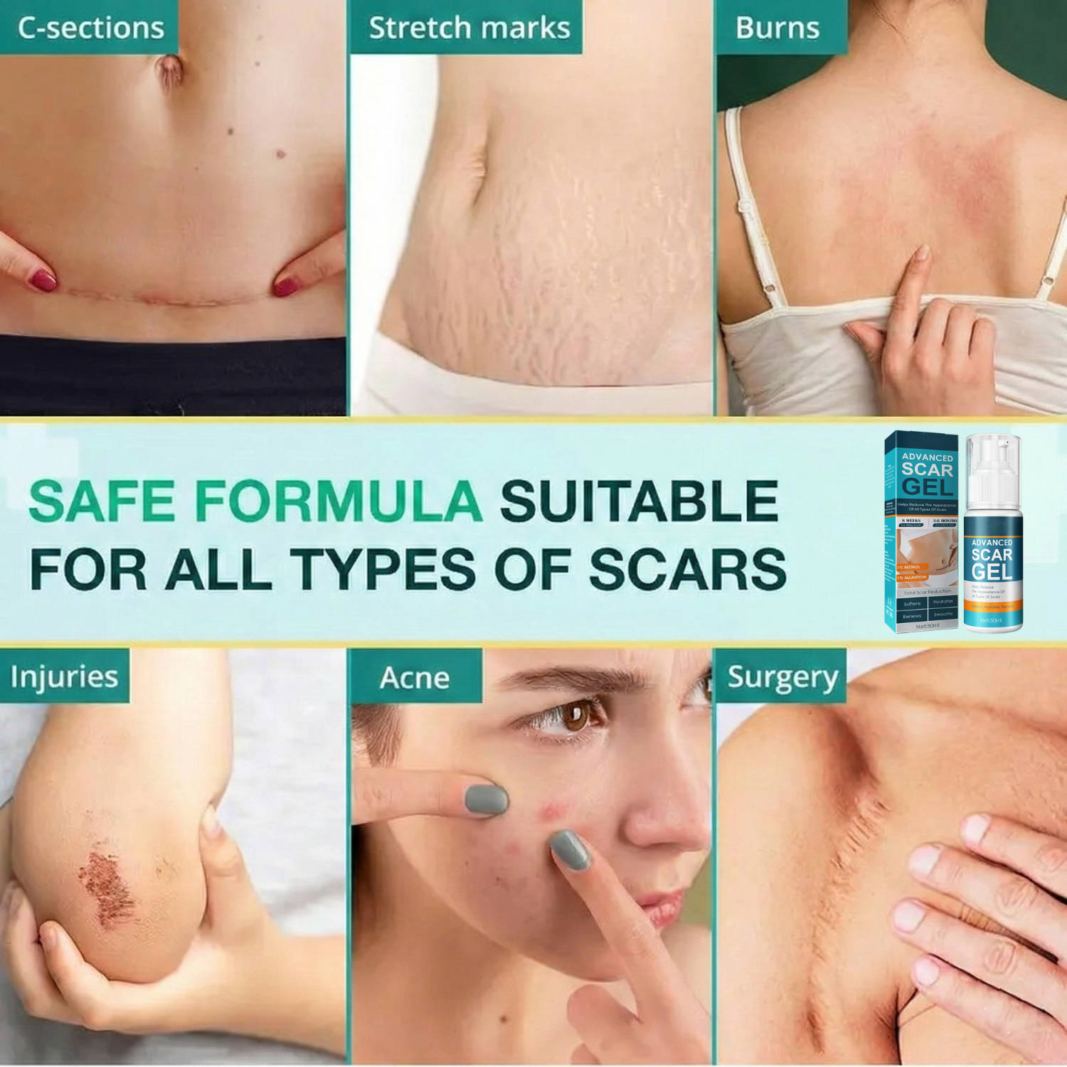 Silicone Scar Gel Moisturizing Cream for Skin Marks and Stretch Marks