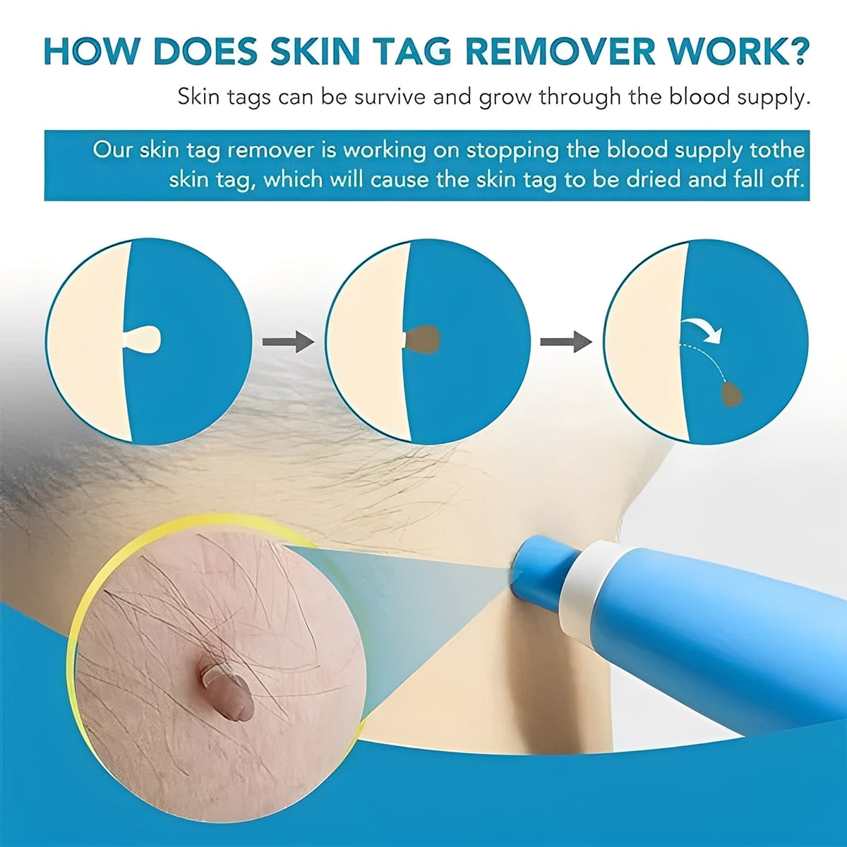 Skin Tag Banding Tool Kit with Applicator and Bands