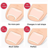 2 Piece Toenail Correction Clip Set with Stainless Steel Straightening Tool for Nail Care