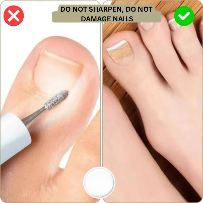 Instant Nail Repair Corrector for Ingrown and Damaged Nails
